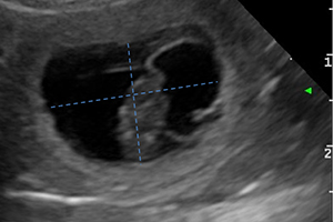 Echo-gestation