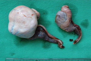 Lire la suite à propos de l’article Testicular tumors